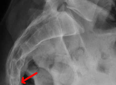 Koksiks Kırığı Belirtileri Nelerdir?