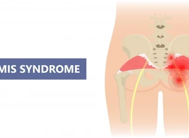 Piriformis Sendromu Nedir?