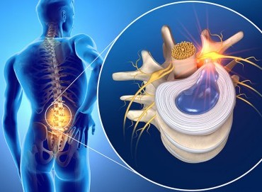Bel Fıtığı Ameliyat Sonrası Neden Tekrarlar?