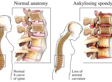 Ankilozan Spondilit Nedir? 