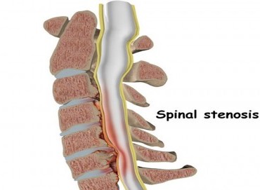 Kanal Darlığı (Stenoz) Nedir?