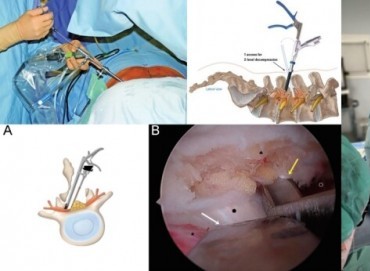 Sinir Sıkışmalarında Mikrocerrahi vs. Endoskopik Cerrahi: Hangisi Daha Etkili?