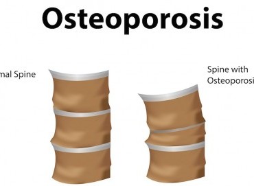 Kemik Erimesine Bağlı Omurga Kırıkları ve Tedavi Yöntemleri Nelerdir? 