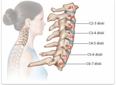 Mikrocerrahi İle Boyun Fıtığı Tedavisi