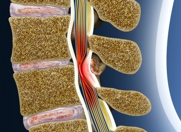 Omurga Enfeksiyonları: Nedenleri, Belirtileri ve Tedavisi