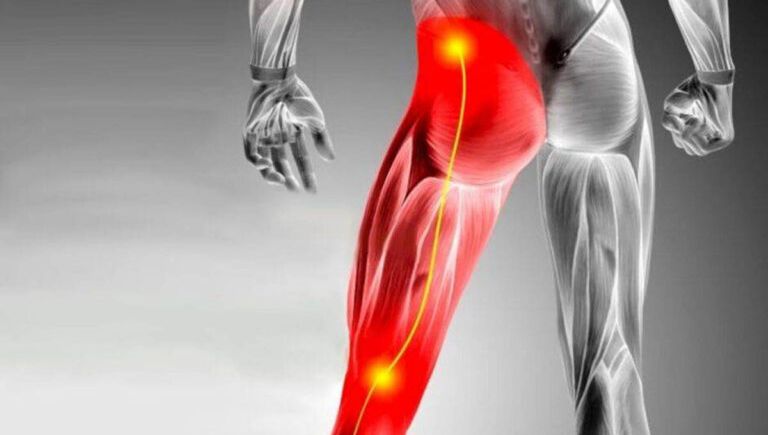 Siyatik Ağrısı Tedavisi